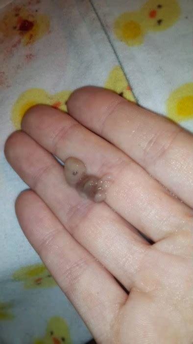 miscarriage at 7 weeks.